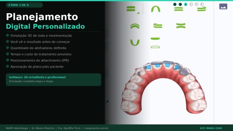 Planejamento ortodôntico digital - alinhadores invisíveis Balneário Camboriú